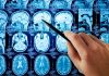 A hand pointing at MRI brain scans displayed on a screen