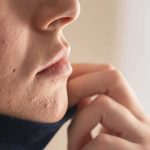 Teens Hammer Faces for ‘Perfect’ Jawlines Close-up of lower face with acne scars and hand pulling up fabric
