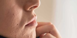 Close-up of lower face with acne scars and hand pulling up fabric