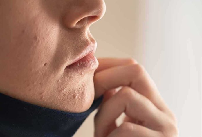 Close-up of lower face with acne scars and hand pulling up fabric