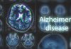 MRI brain scan highlighting Alzheimer's disease