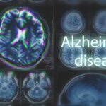 MRI brain scan highlighting Alzheimer's disease