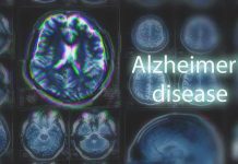 MRI brain scan highlighting Alzheimer's disease